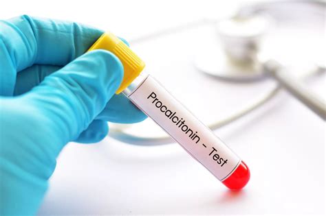 Procalcitonin .